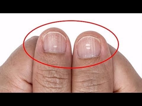 Lütfen Geç Olmadan Kontrol Edin!  Tırnaklarınıza bakın hastalığınızı öğrenin