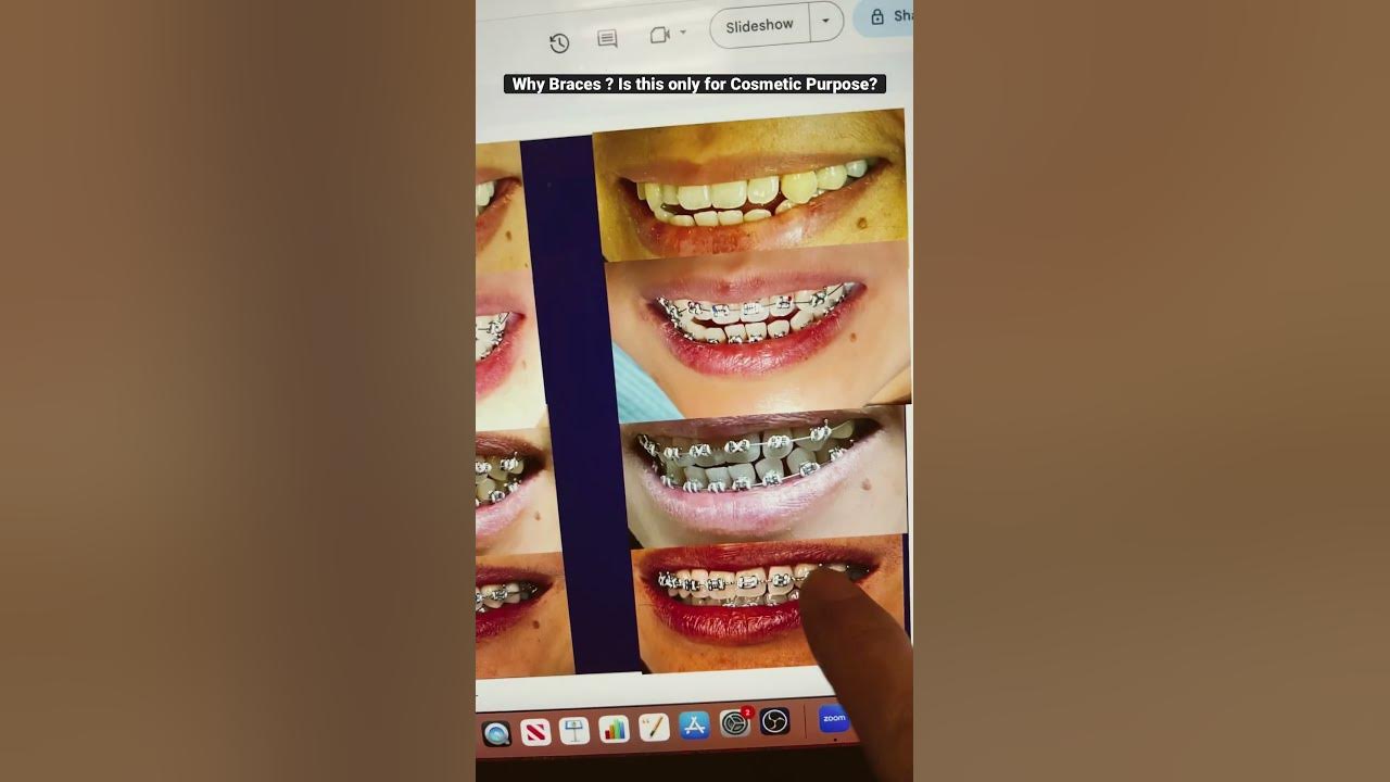 why-do-people-need-braces-is-this-purely-cosmetic-reason-youtube