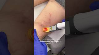 Say good bye to those annoying red and purple veins on you legs this winter ✨👇🏼