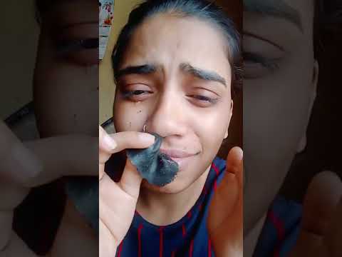 removing painful charcoal