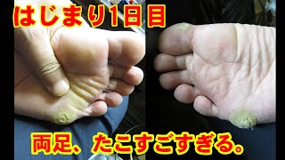 はじまり1日目：両足、たこすごすぎる。help me