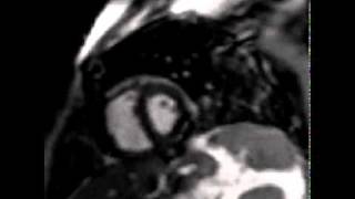Assessment of ventricular coupling with real-time cine MRI and its value to differentiate constrict