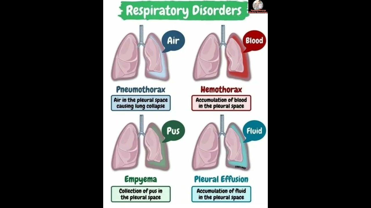 What are the pneumothorax hemothorax ,empyema & pleural effusion