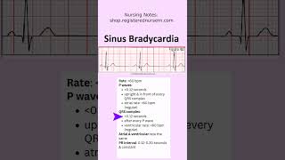Sinus Bradycardia ECG EKG Nursing: Treatment, Rhythm Made Easy in Less Than 1 Minutes #nursing #ecg