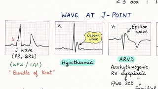J-Point ECG | DELTA WAVE | OSBORN WAVE | EPSILON WAVE
