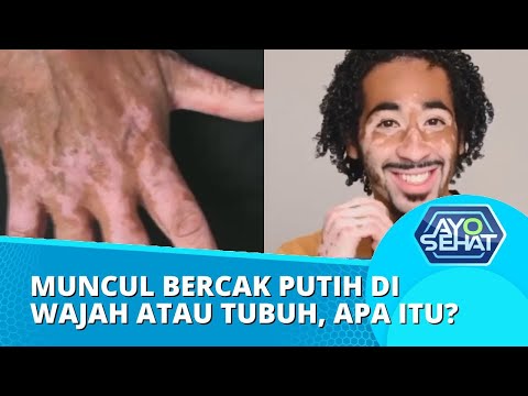 Video: Adakah vitiligo merebak kepada orang lain?