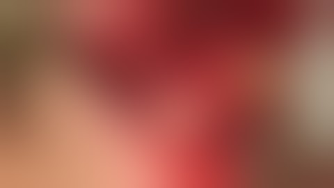 Lateral Bone Augmentation by AutoGraft Bone Block -( Symphysis )- Short Movie