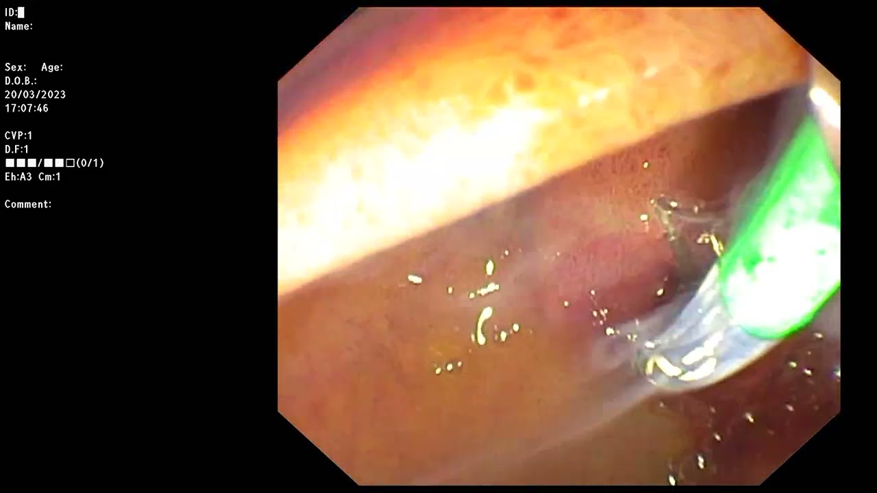 ERCP ; Obvious papillitis with EST of recently passing CBD stone cholangitis.