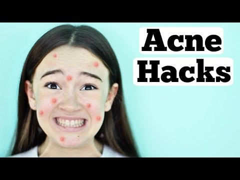 Acne Life Hacks |  Pimples, Blemishes, Acne Hacks for Teens  | Fiona&#;s Fresh Face  | Fiona Frills