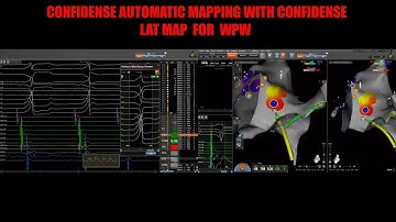 wpw ablation - AUTOMATIC MAPPING