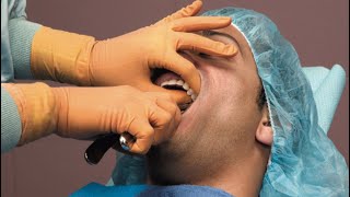 Tooth extraction (simple)