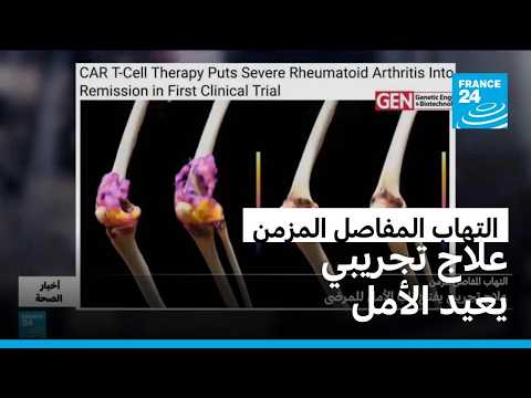 التهاب المفاصل المزمن.. علاج تجريبي يفتح باب الأمل للمرضى