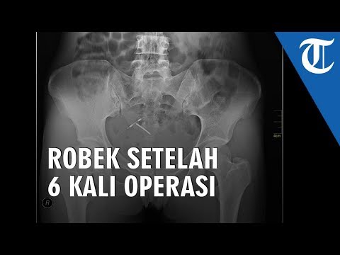 6 Kali Operasi Kelamin, Wanita Ini Alami Luka Robek Sepanjang 1,2 Sentimeter