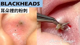 耳朵裡的黑頭(blackheads in ear) - Taiwan Tainan台南清粉刺最乾淨