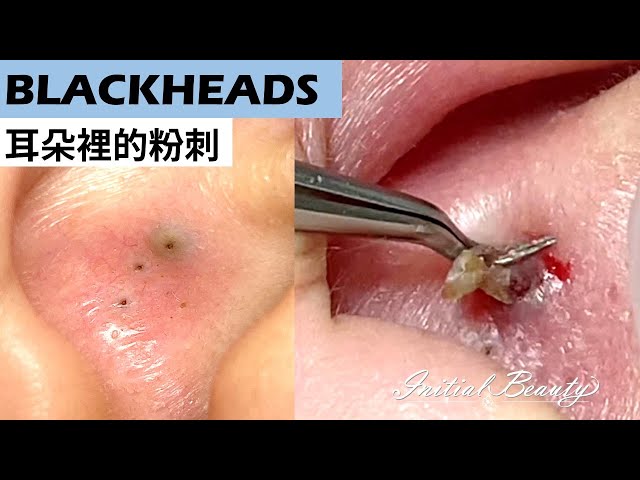 耳朵裡的黑頭(blackheads in ear) - Taiwan Tainan台南清粉刺最乾淨