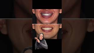 Corrección de asimetría con ortodoncia!!!!🙏🏻 #bracket #dentista #dentist #orthodontist