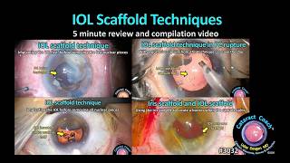 CataractCoach™ 3032: IOL scaffold techniques review & compilation video