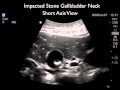 How to: Gallblader Ultrasound Part 2 - Gallstones - SonoSite, Inc.