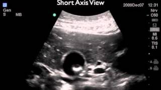 How To: Gallbladder Ultrasound Part 2 - Gallstones Case Study Video