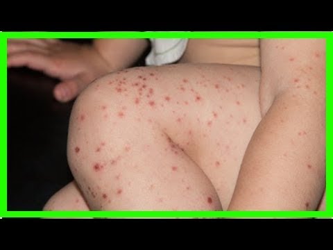 Video: Coxsackie-Virus - Symptome, Behandlung, Prävention, Anzeichen Bei Erwachsenen