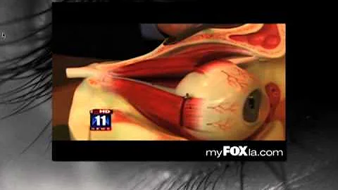 Dr. David B. Granet - Thyroid Eye Disease:  The Ba...