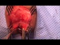 Cloaca  , Urogenital sinus mobilisation