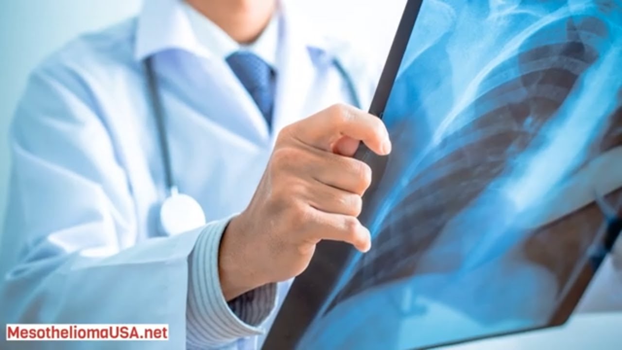 Symptoms Of Mesothelioma - Outlook For Mesothelioma