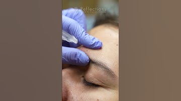 Preventative Botox