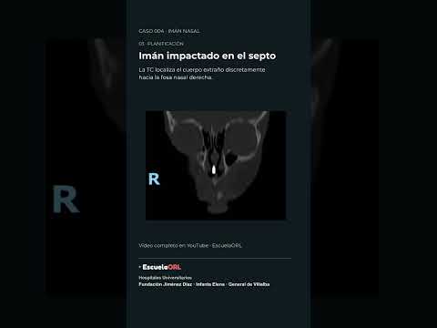 Miniatura: Imán nasal retenido: diagnóstico por imagen | EscuelaORL #Shorts