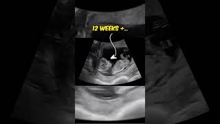 Ultrasound, 12 Weeks Old