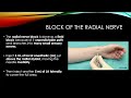 "Motor Sparing” Blocks of the Hand and Feet (Landmark and USG Guided “Wrist” and “Ankle” Blocks)
