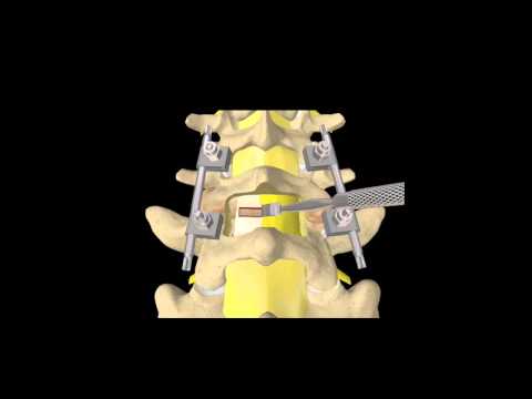 Video: Le viti peduncolari sono sicure?