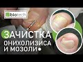 ОНИХОЛИЗИС! КАК ЕГО ЗАЧИЩАТЬ И ПОЧЕМУ ОН ВОЗНИК?!