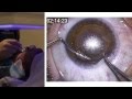London Vision Clinic | ReLEx SMILE | Live laser eye surgery | Professor Dan Reinstein