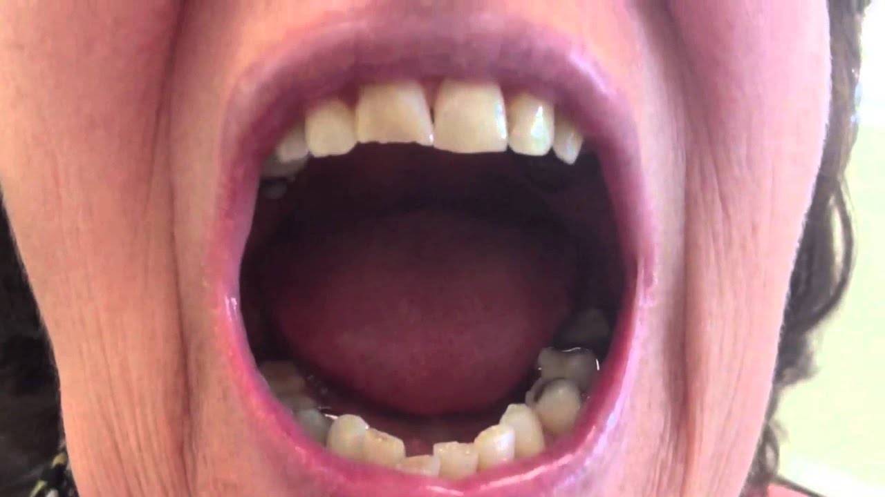 craquement articulaire avec arthrose sévère YouTube