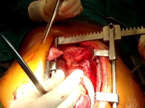 Total Arterial Awake Off Pump Coronary Artery Bypa...