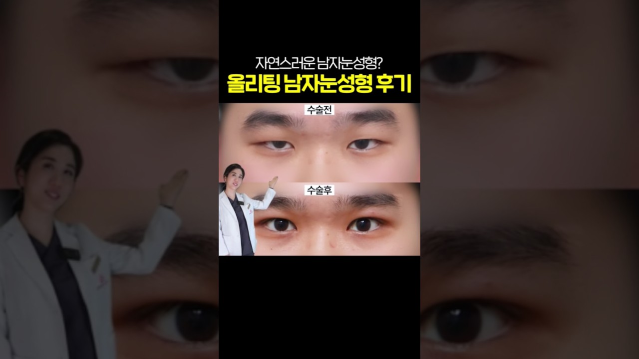 [Олитинг гоо сайхны мэс заслын клиник] Эрчүүдээ, одоо хүртэл нүдний гоо сайхны мэс засал хийлгэх талаар зөвхөн бодож байгаа бол, дарна уу!! #давхраа #нүдниймэсзасал #шортс #сэдэв #асуудал