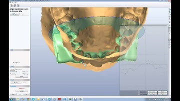 Impression Bite Registration