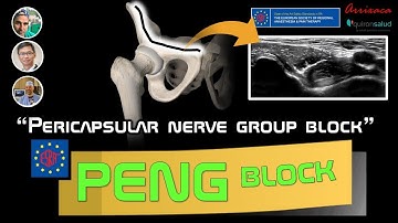 PERICAPSULAR NERVE GROUP BLOCK (PENG BLOCK). OUR CURRENT UNDERSTANDING.