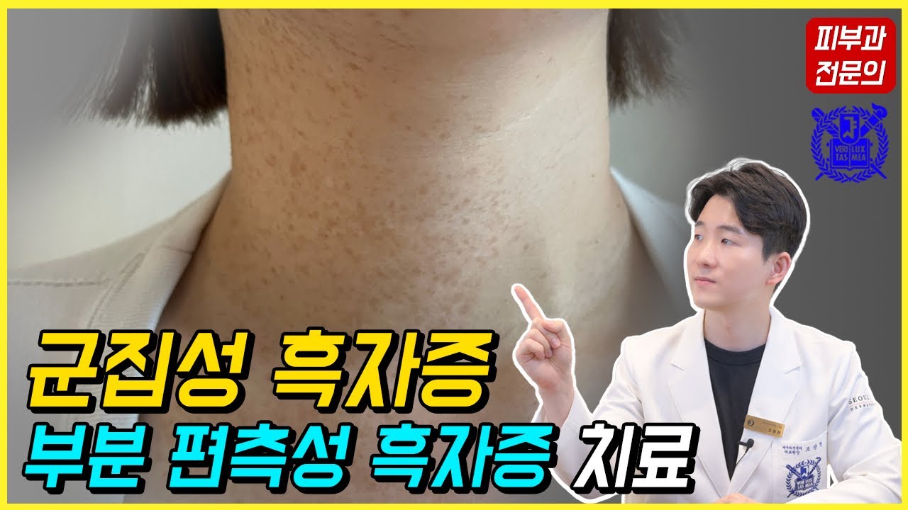 군집성 흑자증, 부분 편측성 흑자증, 일측성 흑자증의 레이저 치료를 알려드립니다. - 피부과전문의 닥터피부광 - YouTube