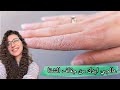 Treat Your Hands For Dryness Eczema And Peeling In Winter 