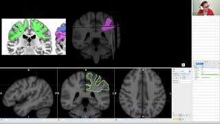 Tractography data visualisation  using Trackvis & SurfIce (Guest lecture at UCL)
