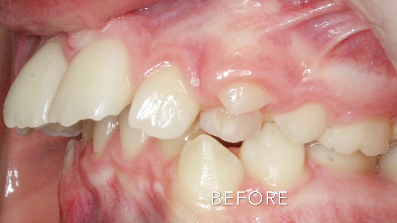 Protect Your Smile by Correcting Protruding/Buck Teeth - YouTube
