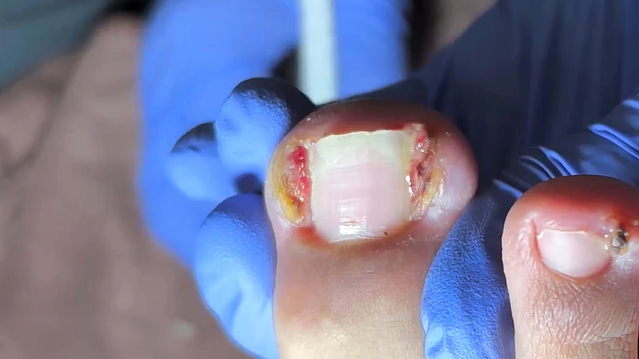 Relaxing Pedicure Tutorial Video I#ingrown_nail_clip 【pedicure Wang】