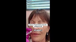 Why I stopped injecting filler directly into smile lines.