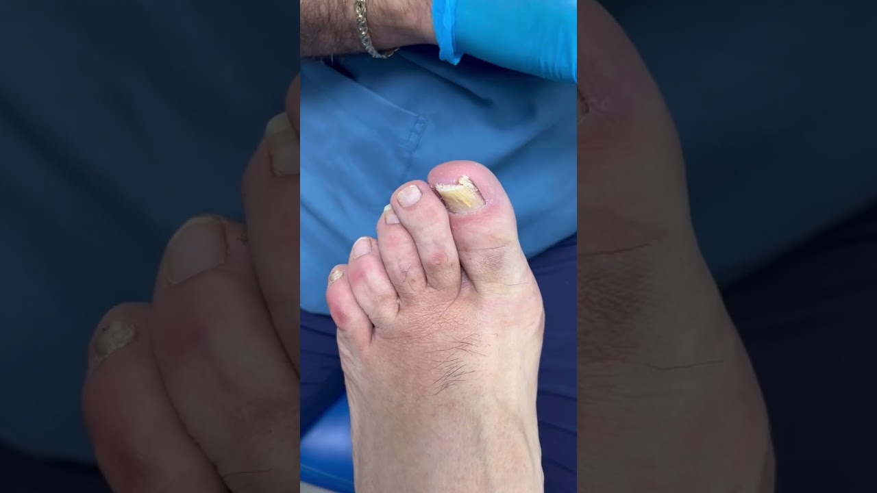 ¿Qué tipos de métodos se utilizan para tratar las uñas encarnadas en un centro podológico en Móstoles?