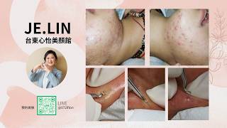 JE無痛清粉刺-下巴粉刺痘痘處理 #林季儀老師 #美容創業