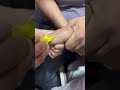 IV Cannulation Easy Method | Full Hindi#CannulaLavate #IVCannulation #NursingSkills #MedicalProc