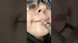 removing tattoos on lips with picosecond laser💥#shorts