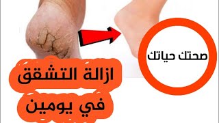 ازالة تشقق القدمين في يومين